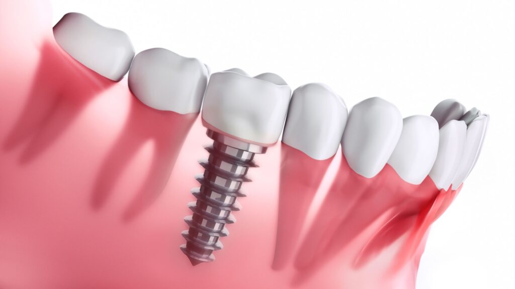 5 Essential Tips for Easy Maintenance of Dental Implants in Downtown Chicago